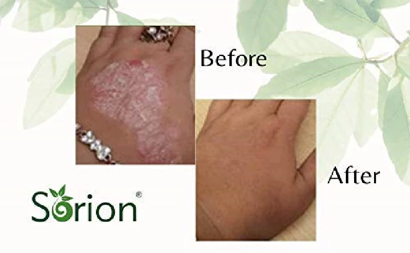 Atrimed Sorion Cream For Dry, Itchy & Flaky Skin, With Neem and Turmeric - Image 4