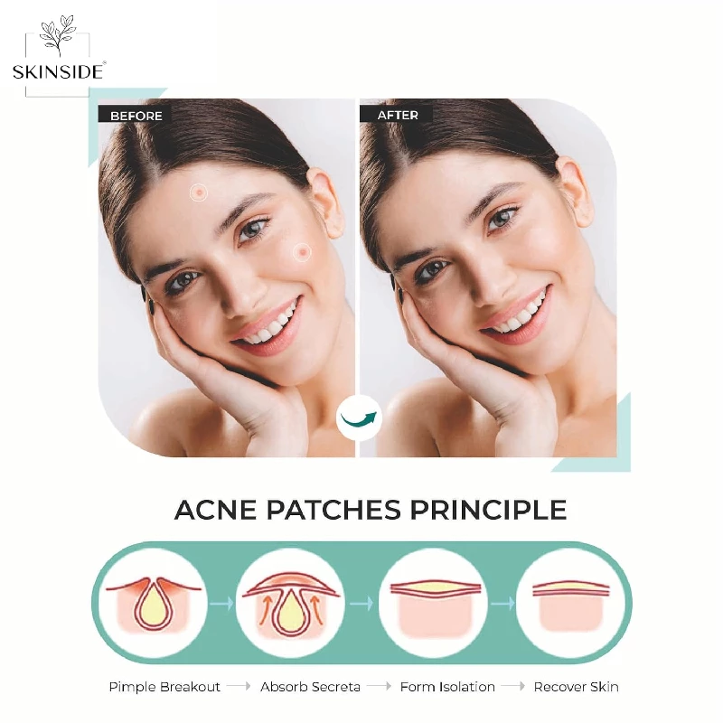 Skinside Acne Pimple Patches for Face Pimple - Image 6