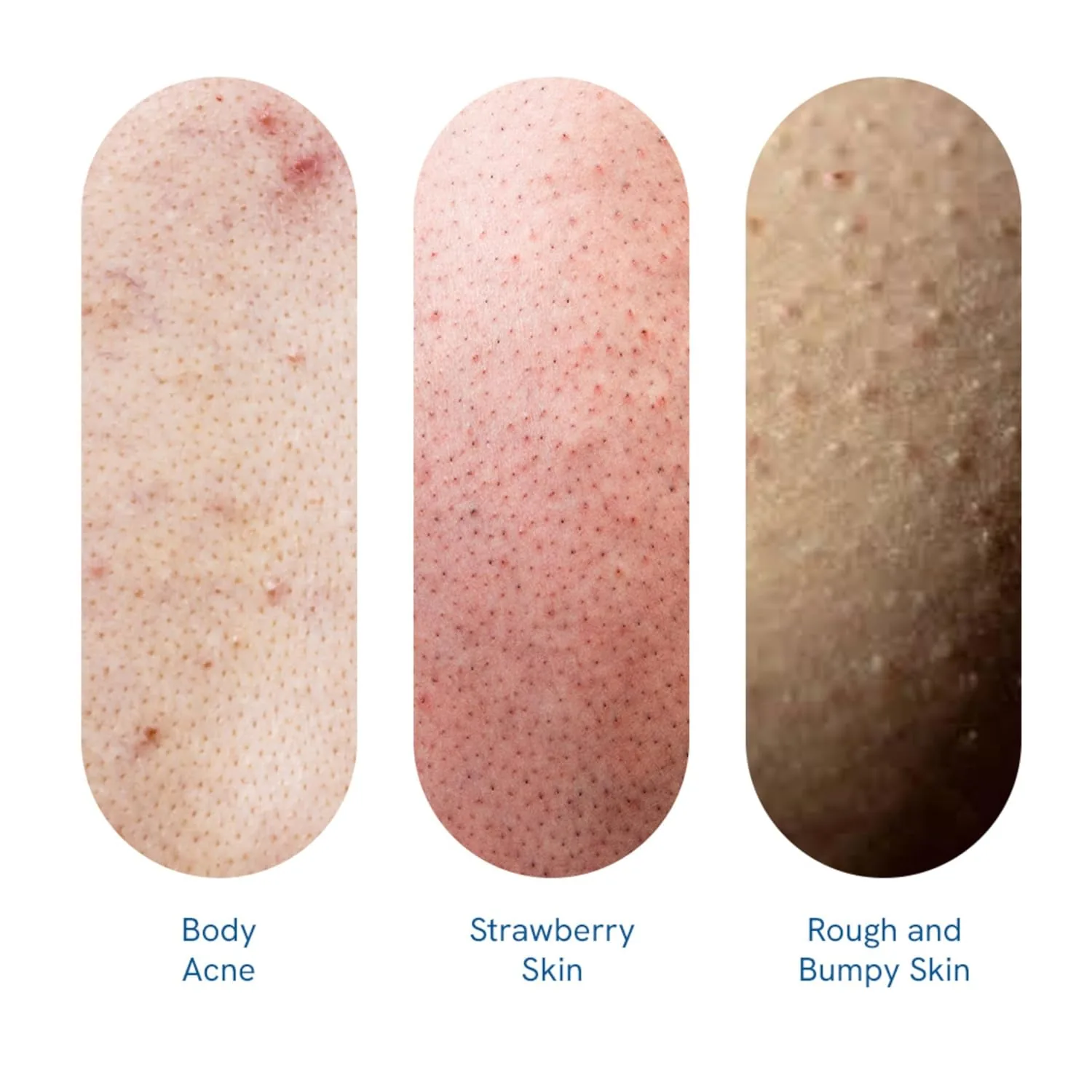 BeBodywise 1% Salicylic Acid Body Wash | Exfoliating Shower Gel | Clear Skin Formula-3