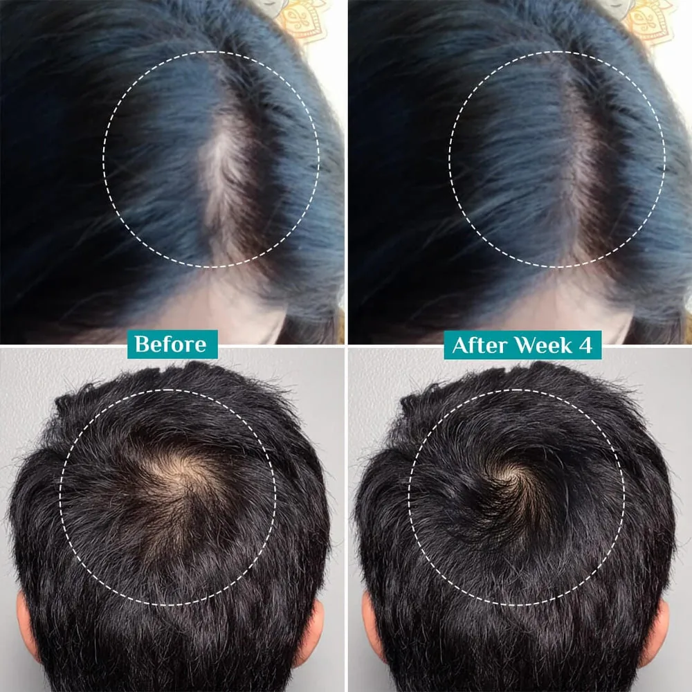 Pilgrim 3% Redensyl, 4% Anagain & 5% Capilia Stem Cell Complex Advanced Hair Growth Serum Roll-On | Scalp Nourishing Serum | Advanced Hair Growth Formula-5